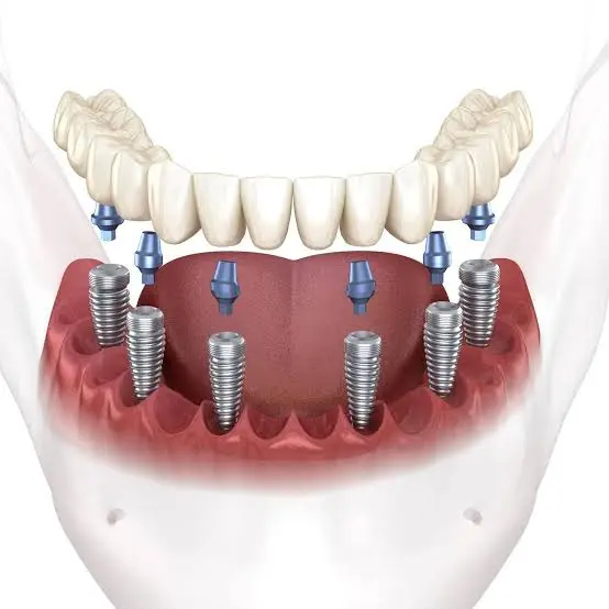 Dentist explaining treatment with a dental model